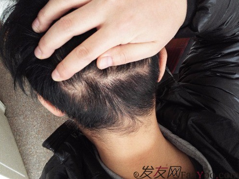 發(fā)際線種植1800單位，六個(gè)月蛻變歷程