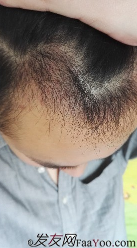 發(fā)際線種植1800單位，六個(gè)月蛻變歷程