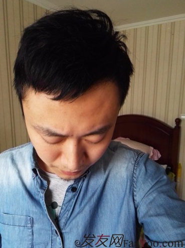 發(fā)際線種植1800單位，六個(gè)月蛻變歷程