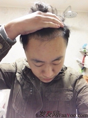 發(fā)際線種植1800單位，六個(gè)月蛻變歷程