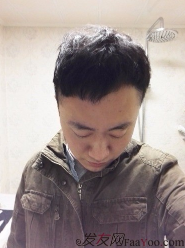 發(fā)際線種植1800單位，六個(gè)月蛻變歷程