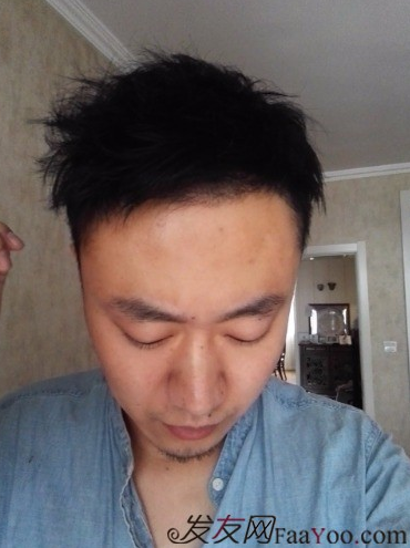 發(fā)際線種植1800單位，六個(gè)月蛻變歷程