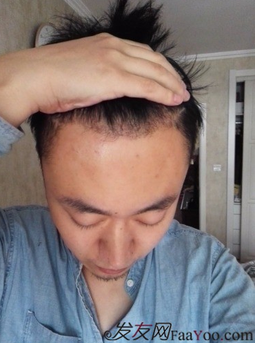 發(fā)際線種植1800單位，六個(gè)月蛻變歷程