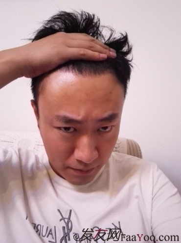 發(fā)際線種植1800單位，六個(gè)月蛻變歷程