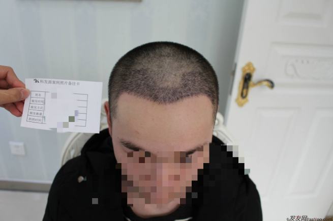 杭州大麥微針植發(fā)2300單位案例，來自脫發(fā)者的內(nèi)心陳述