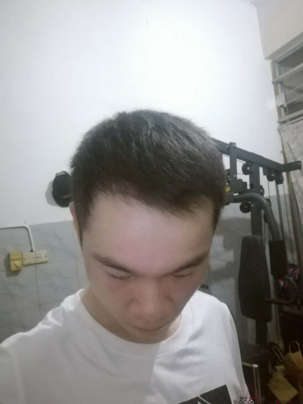 杭州大麥微針植發(fā)2300單位案例，來自脫發(fā)者的內(nèi)心陳述