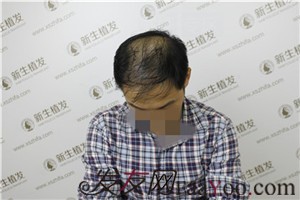 6級脫發(fā)，廣州新生植發(fā)對我做了什么！