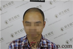 6級脫發(fā)，廣州新生植發(fā)對我做了什么！