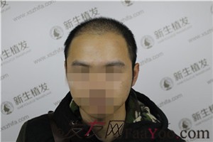 6級脫發(fā)，廣州新生植發(fā)對我做了什么！