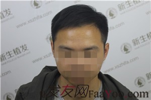 6級脫發(fā)，廣州新生植發(fā)對我做了什么！
