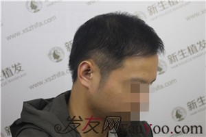 6級脫發(fā)，廣州新生植發(fā)對我做了什么！