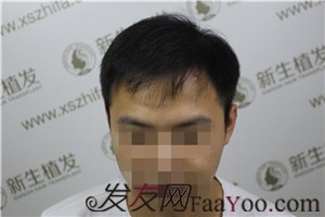6級脫發(fā)，廣州新生植發(fā)對我做了什么！