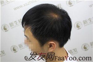6級脫發(fā)，廣州新生植發(fā)對我做了什么！