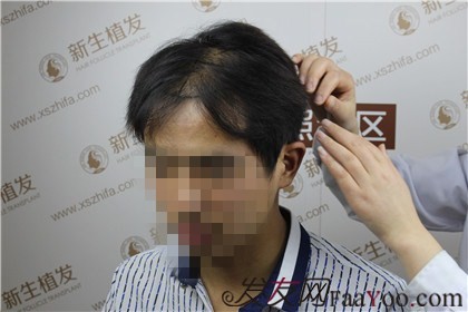 杭州新生植發(fā)，遠(yuǎn)離脫發(fā)改變形象