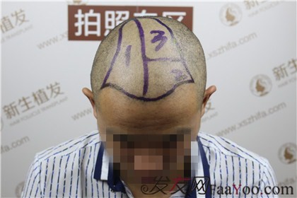 杭州新生植發(fā)，遠(yuǎn)離脫發(fā)改變形象