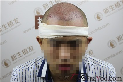 杭州新生植發(fā)，遠(yuǎn)離脫發(fā)改變形象