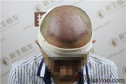 杭州新生植發(fā)，遠(yuǎn)離脫發(fā)改變形象