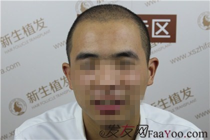杭州新生植發(fā)，遠(yuǎn)離脫發(fā)改變形象