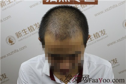 杭州新生植發(fā)，遠(yuǎn)離脫發(fā)改變形象