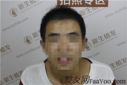 杭州新生植發(fā)，遠(yuǎn)離脫發(fā)改變形象
