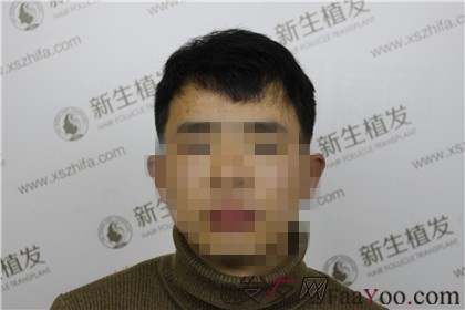 杭州新生植發(fā)，遠(yuǎn)離脫發(fā)改變形象