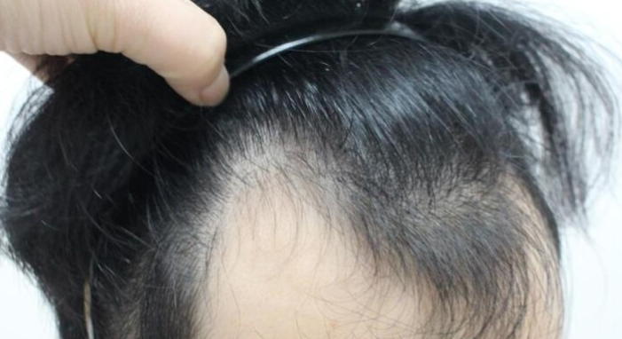 廣州大麥微針植發(fā)2000個單位，我來分享一下植發(fā)經歷