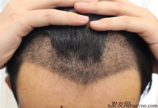 廣州大麥微針植發(fā)2000個單位，我來分享一下植發(fā)經歷