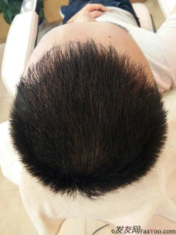 廣州大麥微針植發(fā)2000個單位，我來分享一下植發(fā)經歷