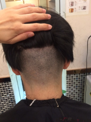 在深圳大麥微針植發(fā)2500單位后，期待額角頭發(fā)能茁壯成長