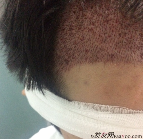 在深圳大麥微針植發(fā)2500單位后，期待額角頭發(fā)能茁壯成長