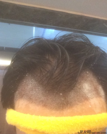 在深圳大麥微針植發(fā)2500單位后，期待額角頭發(fā)能茁壯成長