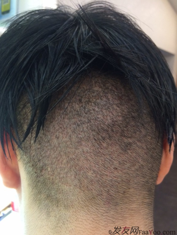 在深圳大麥微針植發(fā)2500單位后，期待額角頭發(fā)能茁壯成長