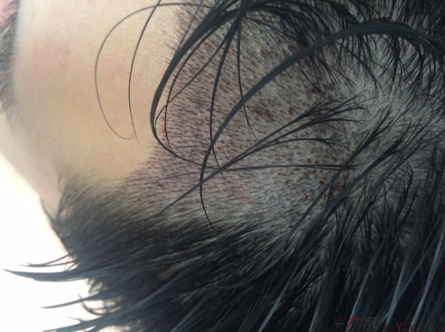 在深圳大麥微針植發(fā)2500單位后，期待額角頭發(fā)能茁壯成長