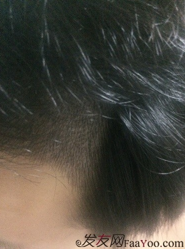 在深圳大麥微針植發(fā)2500單位后，期待額角頭發(fā)能茁壯成長