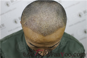 廣州新生植發(fā)，來(lái)幫你實(shí)現(xiàn)夢(mèng)寐以求的事