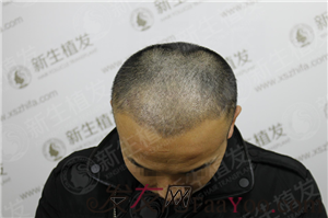 廣州新生植發(fā)，來(lái)幫你實(shí)現(xiàn)夢(mèng)寐以求的事