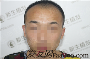 廣州新生植發(fā)，來(lái)幫你實(shí)現(xiàn)夢(mèng)寐以求的事