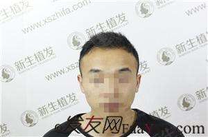 廣州新生植發(fā)，來(lái)幫你實(shí)現(xiàn)夢(mèng)寐以求的事