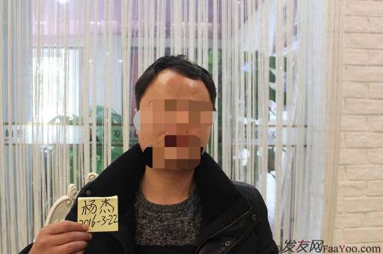 我在上海大麥微針植了發(fā)，看看我的心路歷程