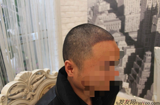 我在上海大麥微針植了發(fā)，看看我的心路歷程