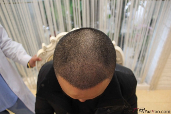 我在上海大麥微針植了發(fā)，看看我的心路歷程