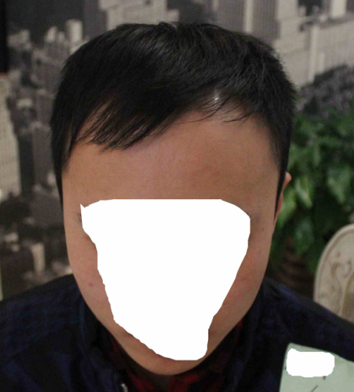 記錄我在上海大麥微針的植發(fā)經(jīng)歷(2500單位)，真是越來越自信了