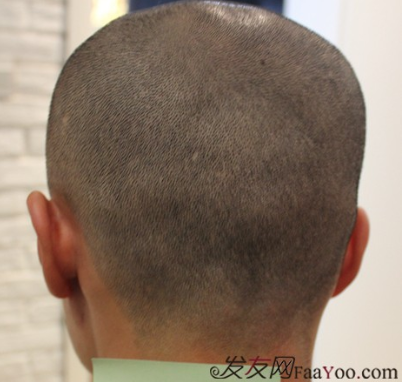 記錄我在上海大麥微針的植發(fā)經(jīng)歷(2500單位)，真是越來越自信了