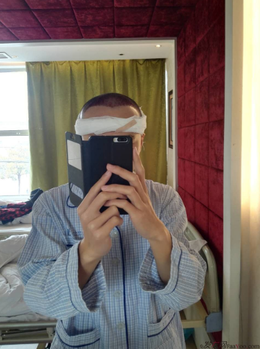 記錄我在上海大麥微針的植發(fā)經(jīng)歷(2500單位)，真是越來越自信了