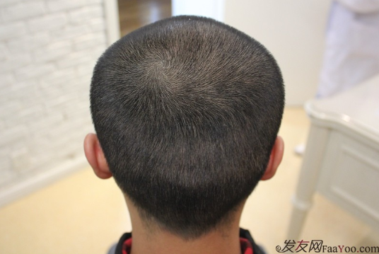 記錄我在上海大麥微針的植發(fā)經(jīng)歷2500單位，真是越來越自信了