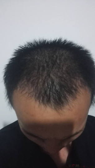 記錄我在上海大麥微針的植發(fā)經(jīng)歷2500單位，真是越來越自信了