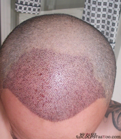 在上海植信植發(fā)歸來，分享一年來的變化