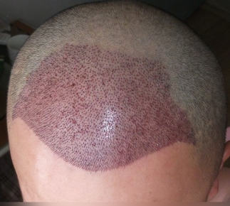 在上海植信植發(fā)歸來，分享一年來的變化