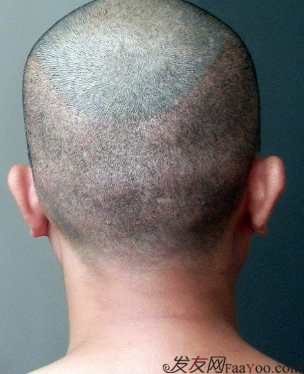 在上海植信植發(fā)歸來，分享一年來的變化