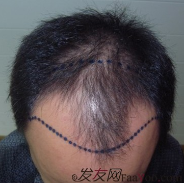 在上海植信植發(fā)歸來，分享一年來的變化